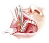 Cirurgia de bichectomia - Cauterização da sutura.