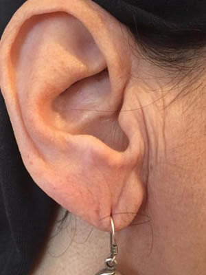 Rejuvenescimento da pele da orelha