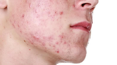 tratamento para acne